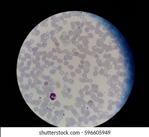 Human Blood Smear With Malaria Infected Red Blood Cells, Under 100X Light Microscope Which Bad Objective Lens Focused.