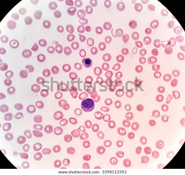 Human Blood Smear Under 100x Light Stock Photo Edit Now 1098513392