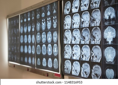 Human Brain MRI On Lightbox In Medical Office