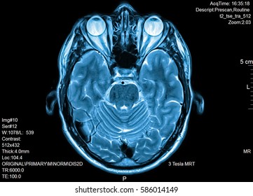 Human Brain Scan By MRI