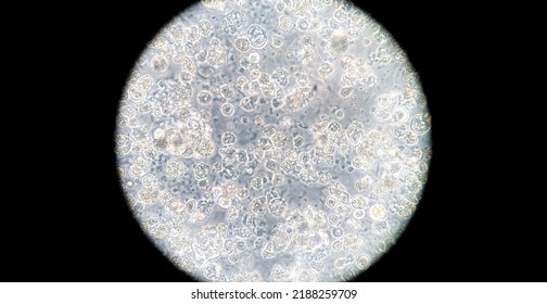 Human Breast Cancer Cells Cultured In Vitro. Microscopic Phase Contrast Image. Cancer Cells Are Used In Biomedical Research, Drug Discovery, Cell Signalling And Genetics. 