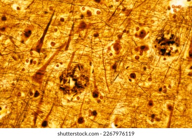 Human cerebral cortex showing two senile plaques, stained with a silver method. They are extracellular deposits of amyloid beta which appear in large numbers in Alzheimer disease