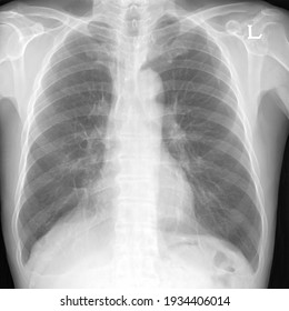 Human Chest Xray Images Abnormal Stock Photo 1934402651 | Shutterstock