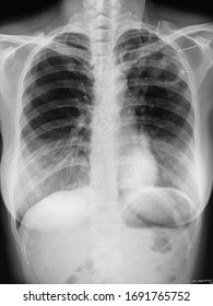 Human Chest X-ray Image Showing Patchy Opacity With A Cavity At Left Upper Lung Zone, Concerning For Active Infections ( Particularly Active TB). Evidence Of Bilateral Breast Implants.