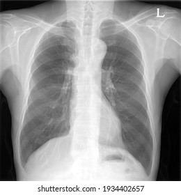 Human Chest Xray Images Abnormal Stock Photo (Edit Now) 1934402627