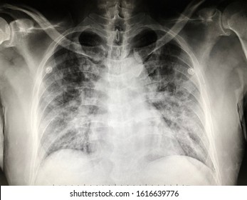 Human Chest X-ray for medical diagnosis.Infection/Infections Respiratory Illnesses and Diseases,Asthma,COPD,Bronchitis,Emphysema, Pneumonia,Cystic Fibrosis/Bronchiectasis,Lung cancer, Pleural effusion