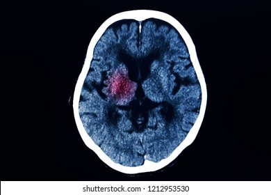 Human computer tomography CT scan of brain level of basal ganglion with red highlight. Blue tone dark background.