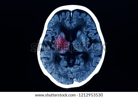 Human computer tomography CT scan of brain level of basal ganglion with red highlight. Blue tone dark background.