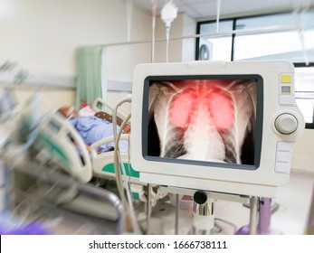 Human Coronavirus Lung Inflammation And Infection Show On Screen In Hospital Patients