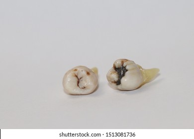 Human Extracted Wisdom Teeth Third Molars Stock Photo 1513081736 ...