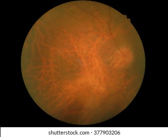 Human eye anatomy, retina, optic disc artery and vein etc. taking images with Mydriatic Retinal cameras