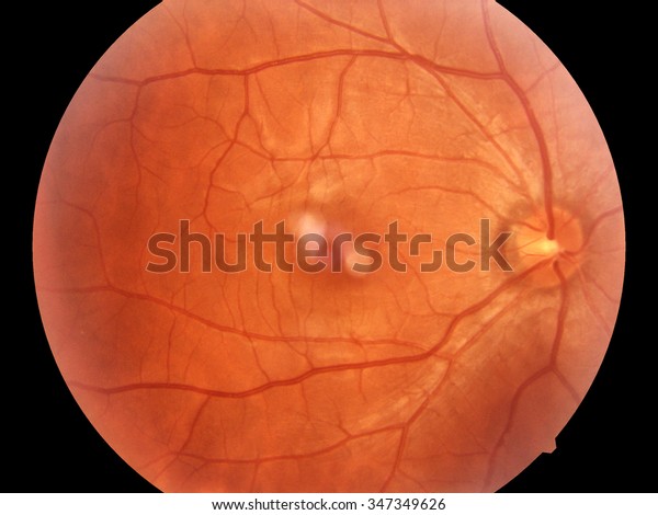 Human eye anatomy, retina, optic disc artery\
and vein (Right), optic nerve\
normal