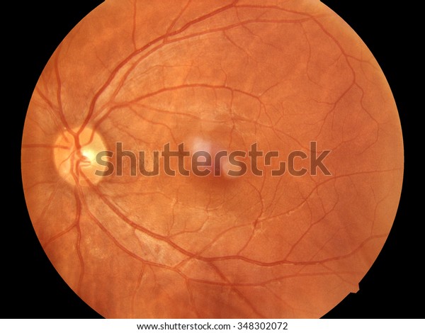 Human eye anatomy, retina, optic disc artery and\
vein(Left), optic nerve\
normal
