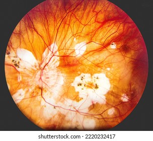 Human eye anatomy showing eye disease. - Shutterstock ID 2220232417