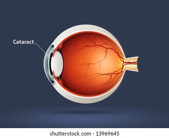 Human Eye - Cataract (eye Disease)