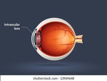 Human Eye - Intraocular Lens