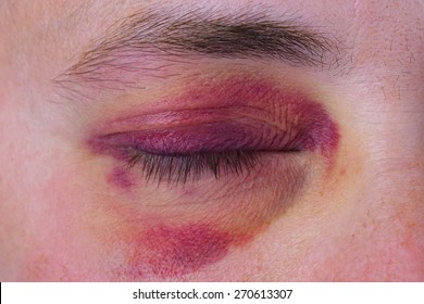 Human Eye With A Large Purple Bruise