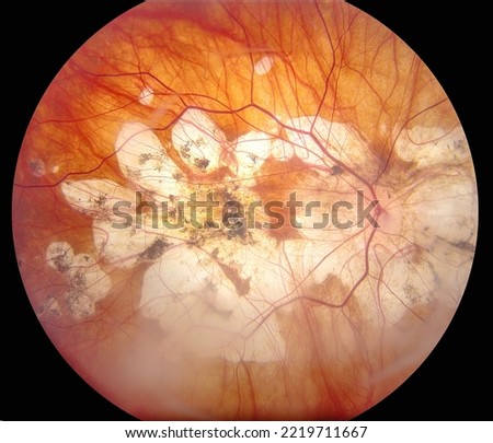 Human eye retinal screening image