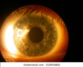 Human Eye Seen Through A Slit Lamp