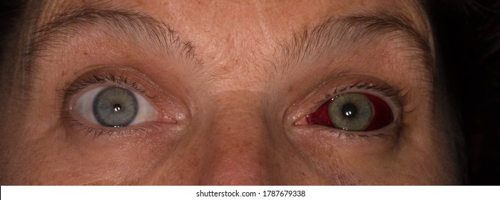 Human Eye With Subconjuctival Hemorrhage, Broken Blood Vessel, Close Up