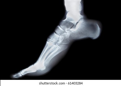 Human Foot Ankel And Leg Xray Picture