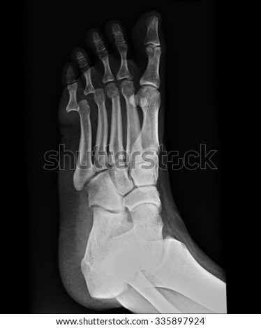 Human foot ankel and leg xray picture.