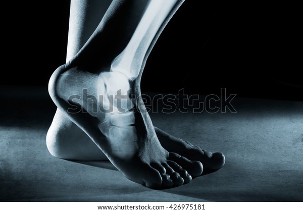 Human\
foot ankle and leg in x-ray, on gray\
background