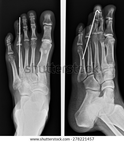Human foots ankel and leg x-ray picture.