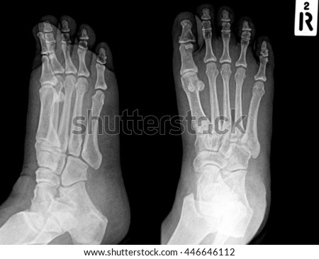 Human foots ankel and leg x-ray picture