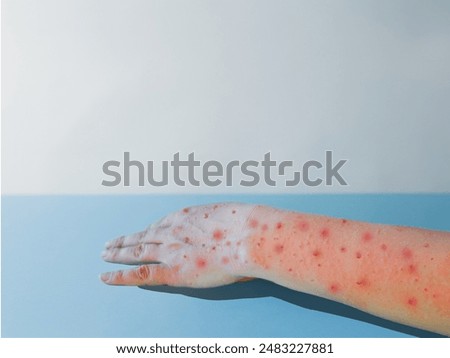 Human hand with Monkey pox virus.