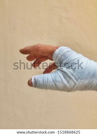 Human hand with soft splint to hold the bone joint and thumb in De Quervain’s Disease physical therapy operation