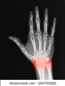 Human Hand And Wrist Pain Caused By Arthritis And Carpal Tunnel Syndrome Injury In The Hand Joint As An Anatomy With Skeleton And Highlighted Injured Body Part As A Medical And Health Care Concept.