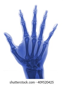 Human Hand Xray Medical Image Stock Photo 409520425 | Shutterstock