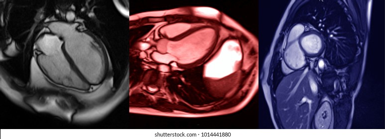 Human Heart, MRI Image. Different Planes Of Heart Imaging