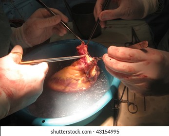 Human Heart Prepared For Transplantation