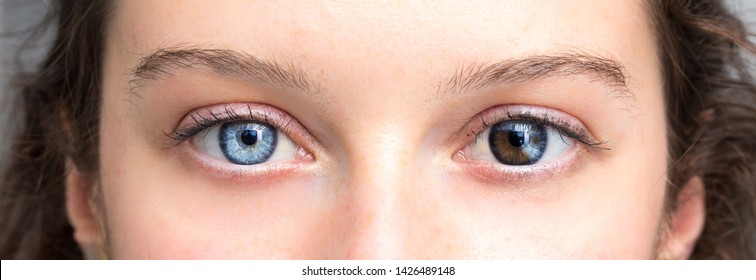 Human heterochromia on eyes of girl, blue one and brown one