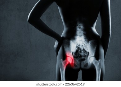 Human hip joint in x-ray on gray background. Painful hip joint is highlighted by red color. X-ray image of painful hip in woman. Osteoarthritis left hip joint at red area mark.