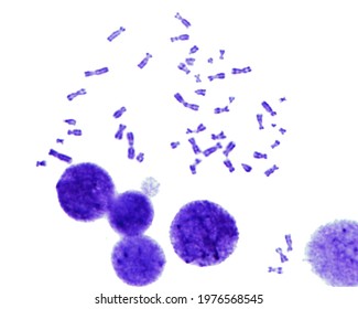 Human karyotype, light micrograph. Human chromosomes stained with Giemsa (G bands).