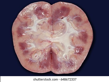 Human kidney cut along its middle plane. In the center is the renal pelvis, divided into calyces that adapt to the tip of the Malpighi’s pyramids (renal medulla). On the outside is the renal cortex. 