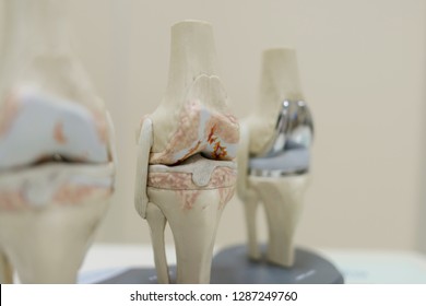 Human knee skeleton model in inclination angle with shallow DOF and selective focus at knee with Osteoarthritis.Total knee replacement prothesis of knee joint in blurred background. Medical concept.