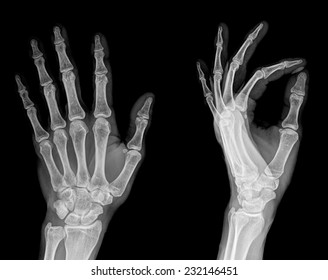 Human Left Hand Xray Medical Image Stock Photo 232146451 | Shutterstock