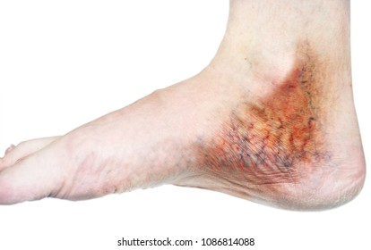 human leg with blocked veins, thrombosis, phlebitis, and standing on a white background, with depth of field Photo
