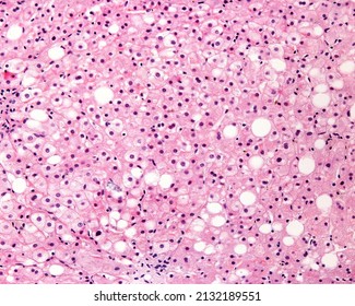 Human liver affected by macrovesicular steatosis (fatty degeneration). Many hepatocytes show a big single fat droplet that pushes the nucleus and cytoplasm to the periphery of the cell. - Shutterstock ID 2132189551