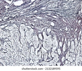 Human Liver. Cirrhosis. High Magnification Micrograph Showing A Regenerating Nodule (top) Surrounded By A Thick Connective Tissue Septum (bottom). Silver Method For Reticular Fibers.