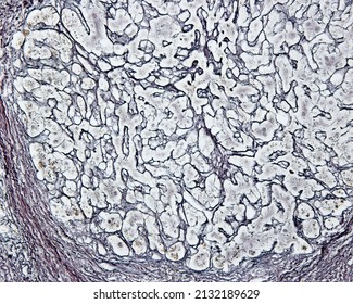 Human Liver. Cirrhosis. High Magnification Micrograph Showing A Regenerating Nodule (top) Surrounded By A Thick Connective Tissue Septum (bottom). Silver Method For Reticular Fibers.