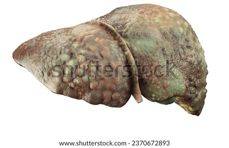 A human liver with cirrhosis is isolated on white background.