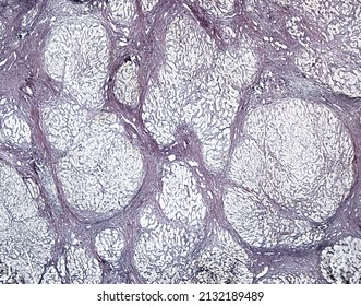 Human Liver. Cirrhosis. Silver Methods For Reticular Fibers Clearly Show The Connective Tissue Septa Surrounding The Regenerating Nodules Of Hepatocytes.