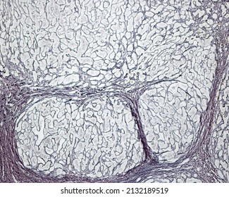 Human Liver. Cirrhosis. Silver Methods For Reticular Fibers Clearly Show The Connective Tissue Septa Surrounding The Regenerating Nodules And The Increase Of Connective Tissue Fibers (fibrosis)