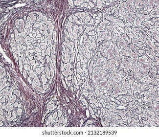 Human Liver. Cirrhosis. Silver Methods For Reticular Fibers Clearly Show The Connective Tissue Septa Surrounding The Regenerating Nodules And The Increase Of Connective Tissue Fibers (fibrosis)