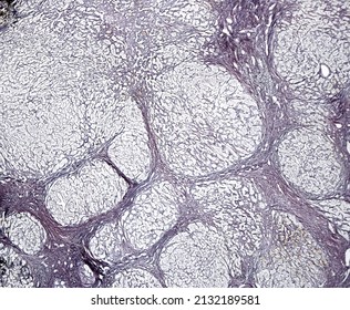 Human Liver. Cirrhosis. Silver Methods For Reticular Fibers Clearly Show The Connective Tissue Septa Surrounding The Regenerating Nodules Of Hepatocytes.